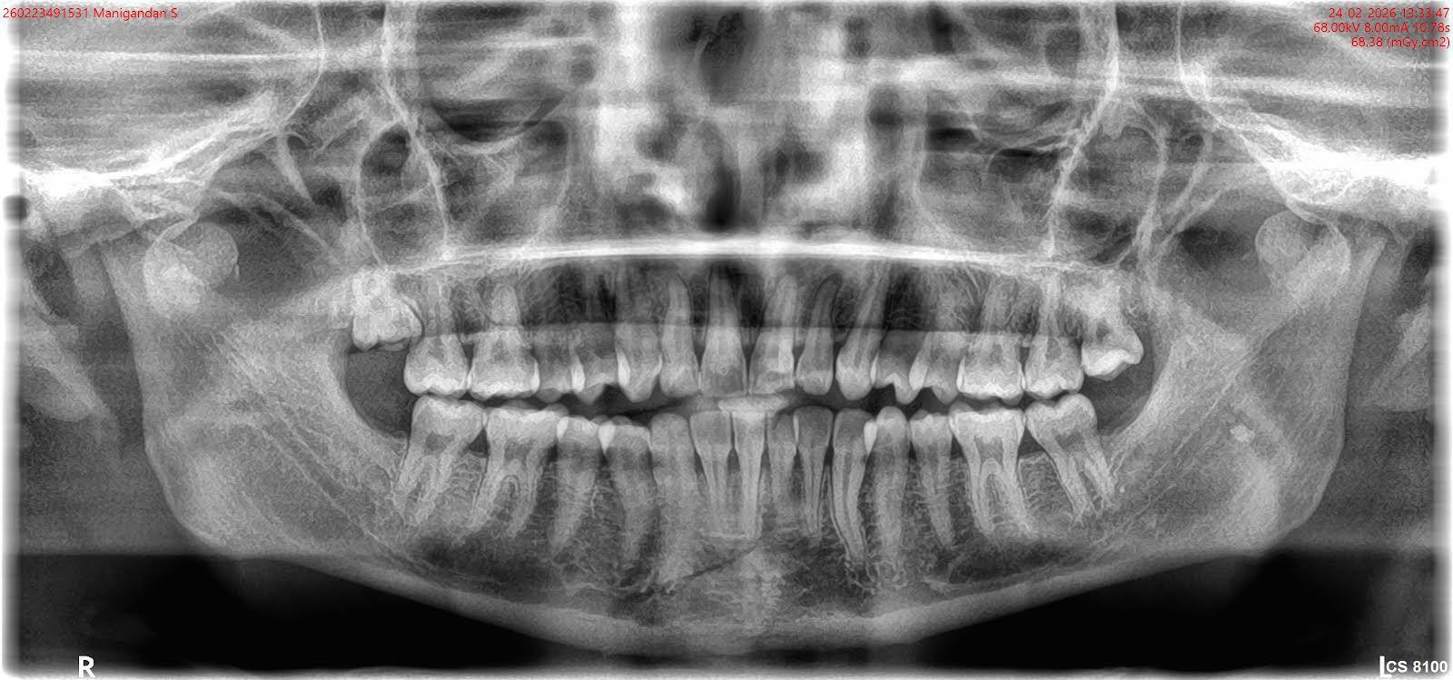 Panoramic dental X-ray