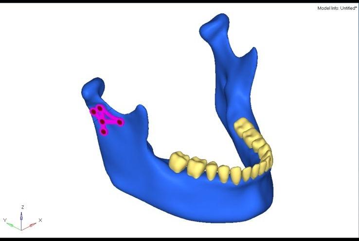 FEA bone displacement