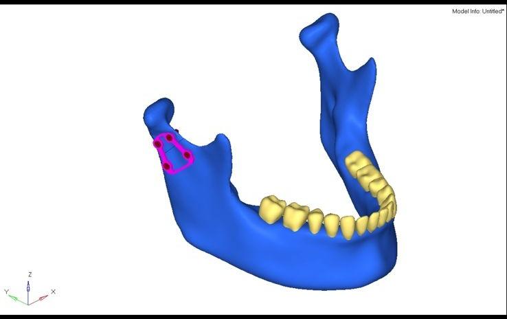 Alpha Plate on mandible — small