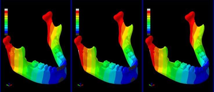 Alpha Plate mounted on mandible 3D model showing anatomical fit at the condylar region