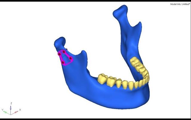 Alpha Plate installed on mandible model